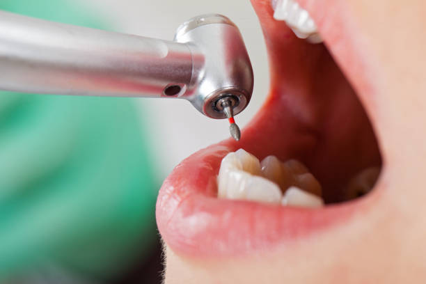 Best Emergency Root Canal Treatment in Turners Falls, MA